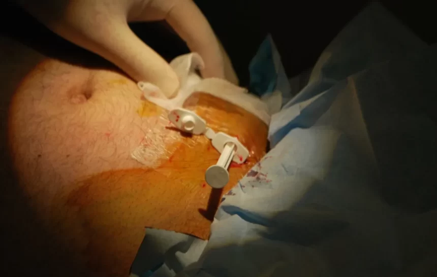 naltrxeone foto Czy istnieje wszywka narkotykowa?